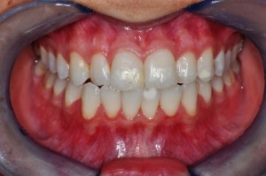 Teeth Whitening In Brighton