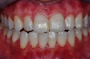 Teeth Whitening In Brighton