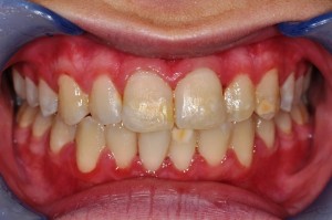 Teeth Whitening In Brighton