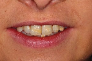 Teeth Whitening In Brighton