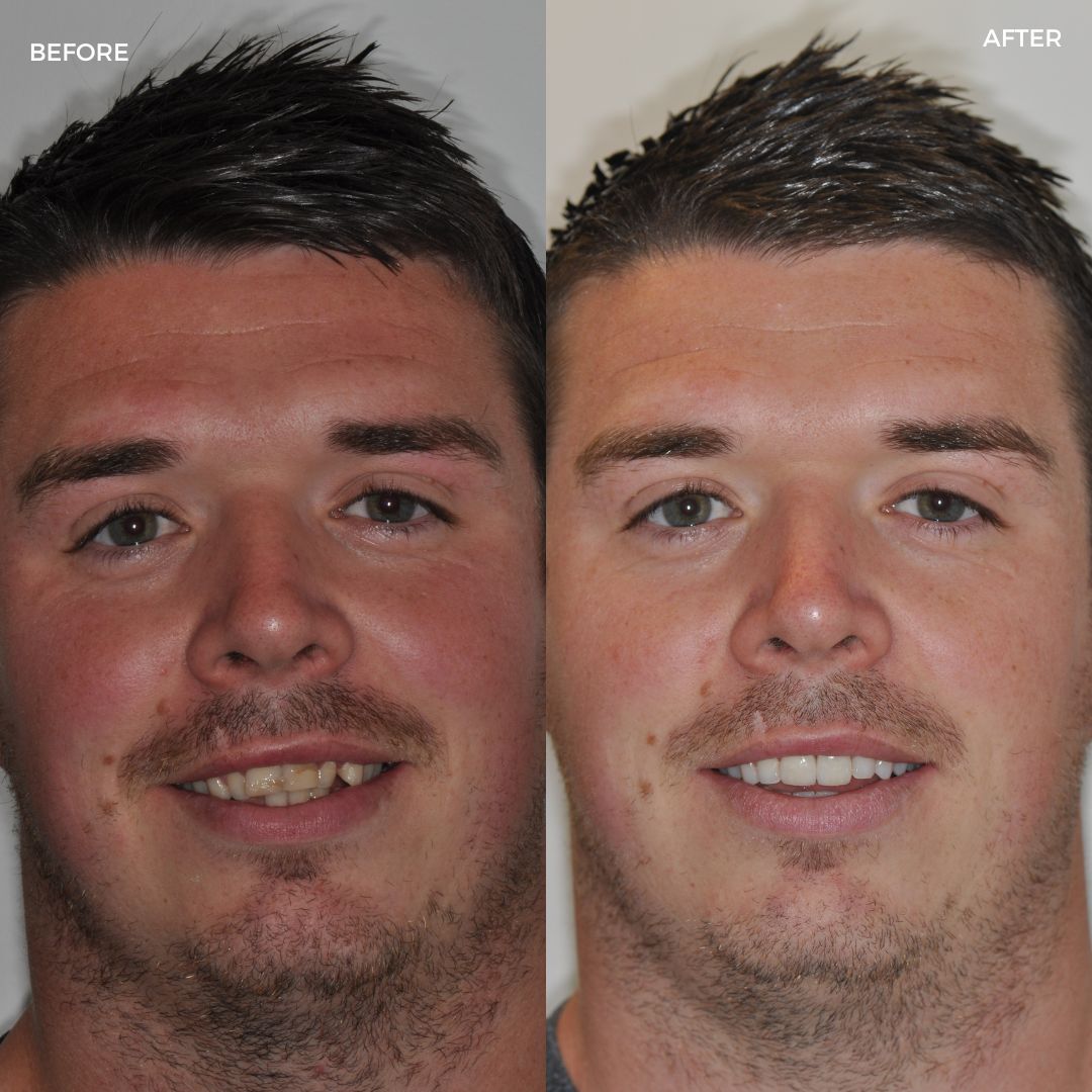 Upper and lower FastBraces, edge bonding and crowns