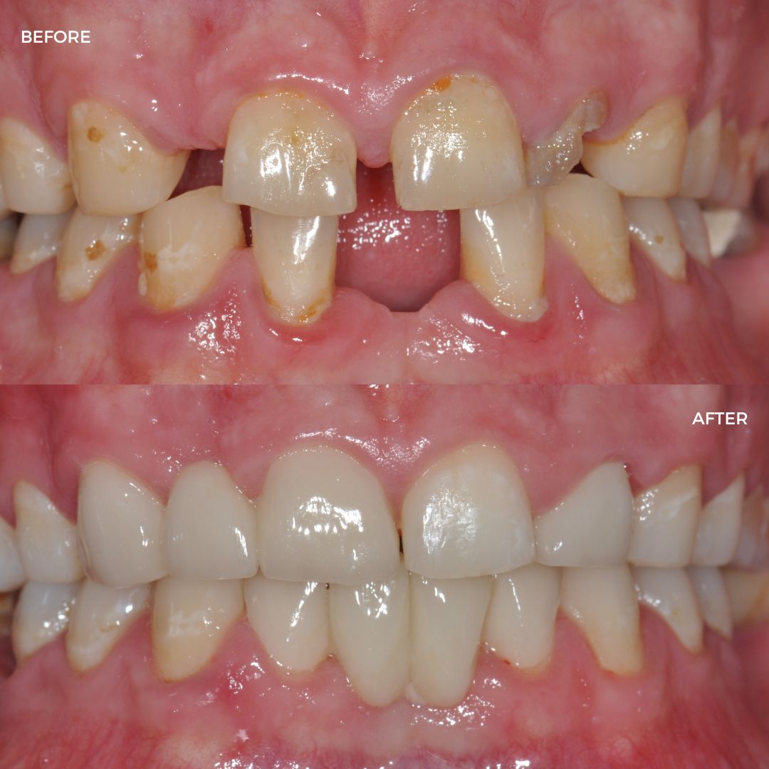 Upper and lower fastBraces finished with crown and bridge