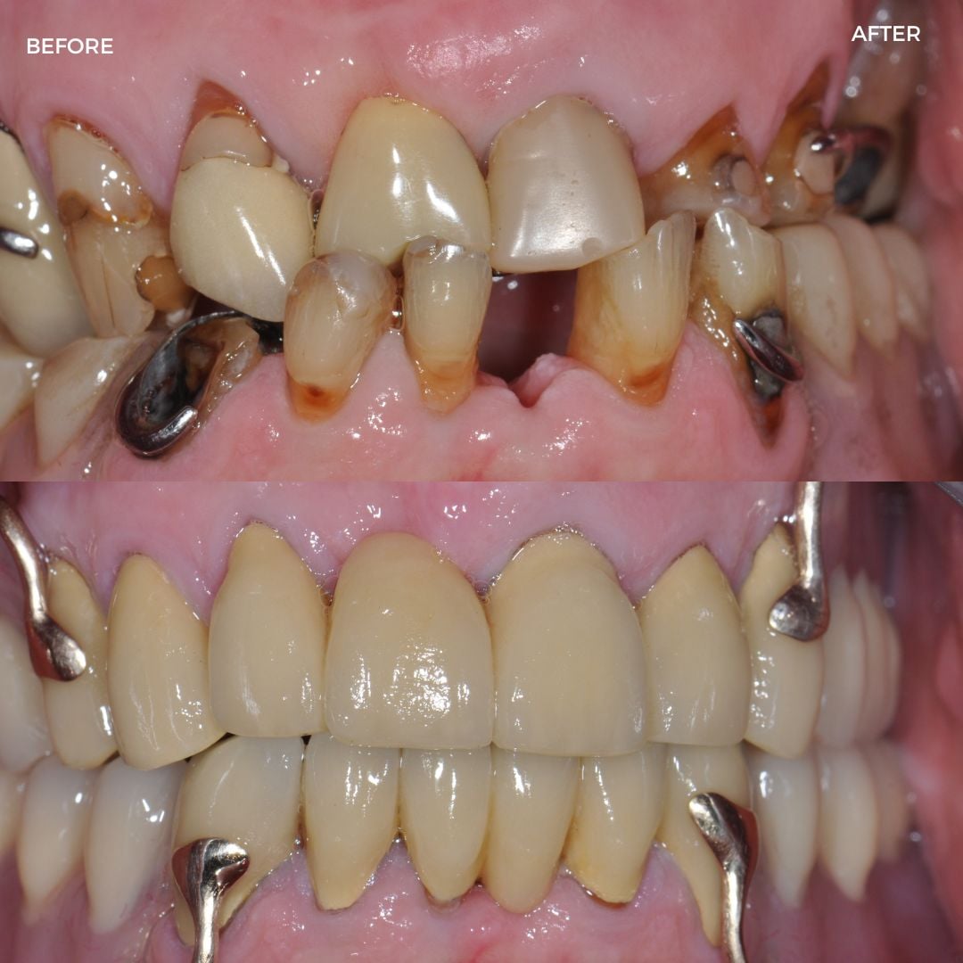 Full mouth rehab with fixed and removable prostheses