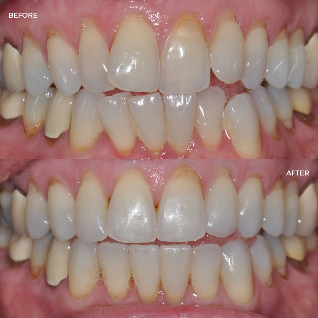 Upper and lower FastBraces and edge bonding