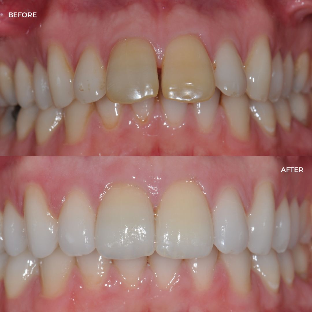 Upper and lower fastBraces 4