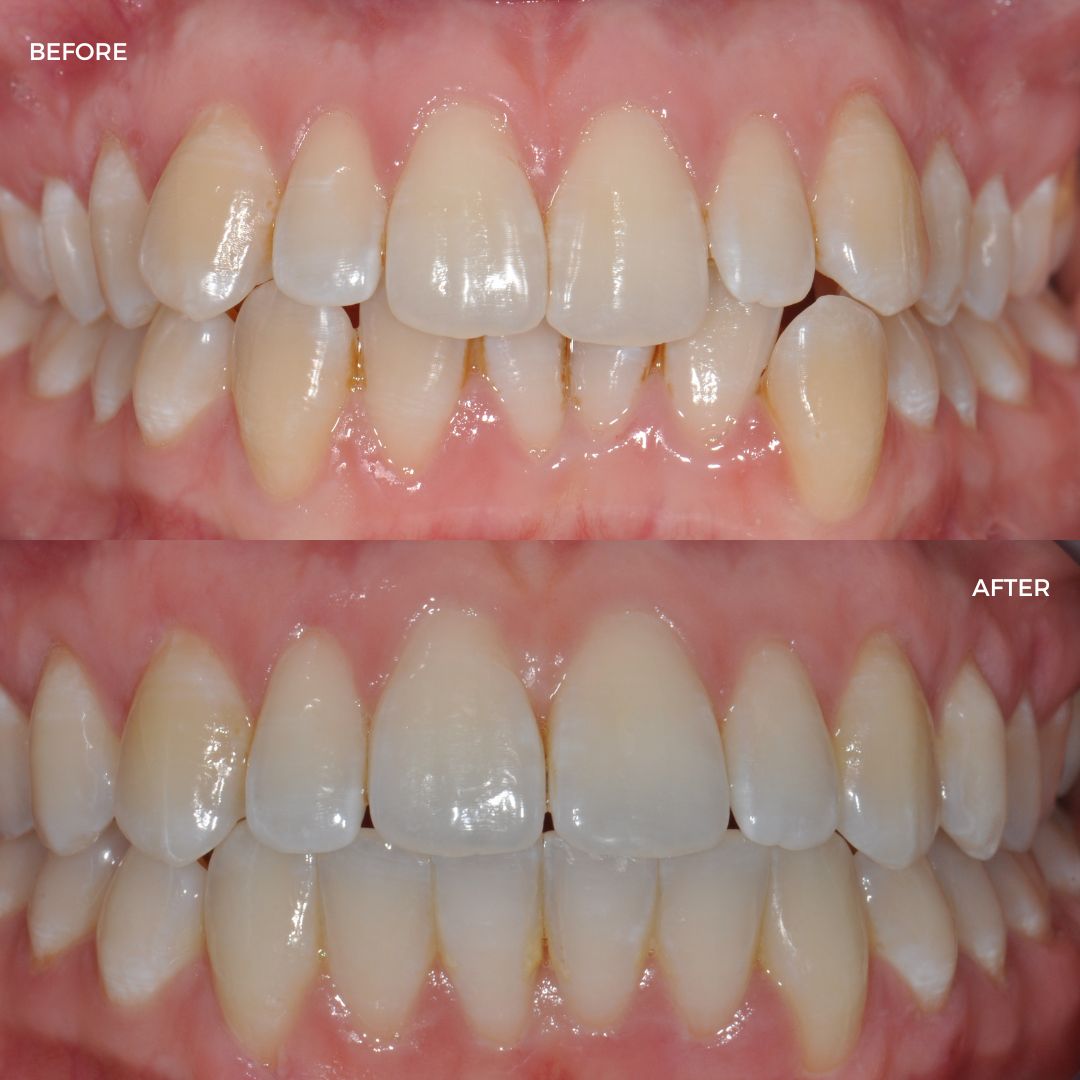 Upper and lower fastBraces 3