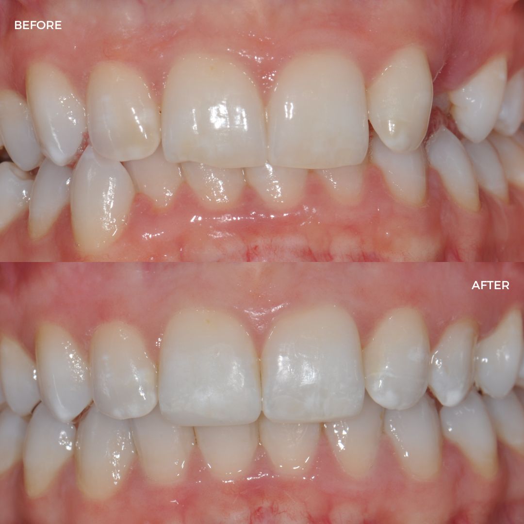 Upper and lower Fastbraces