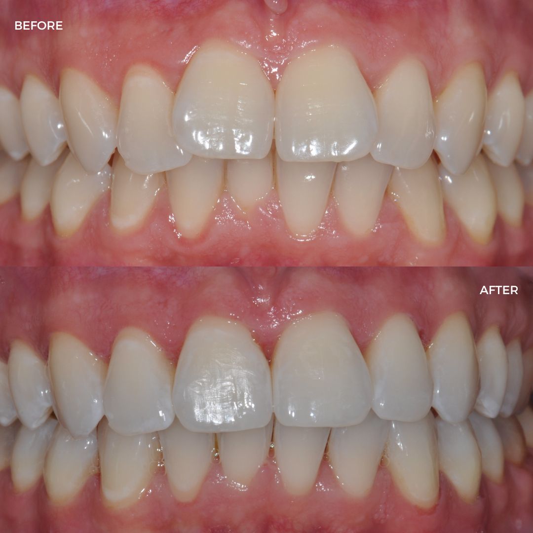 Upper and lower Cfast 3