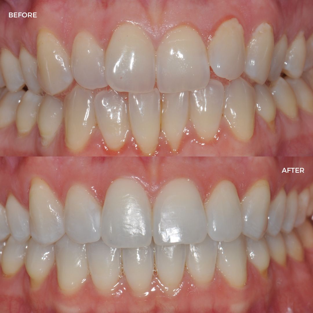 Upper and lower Cfast