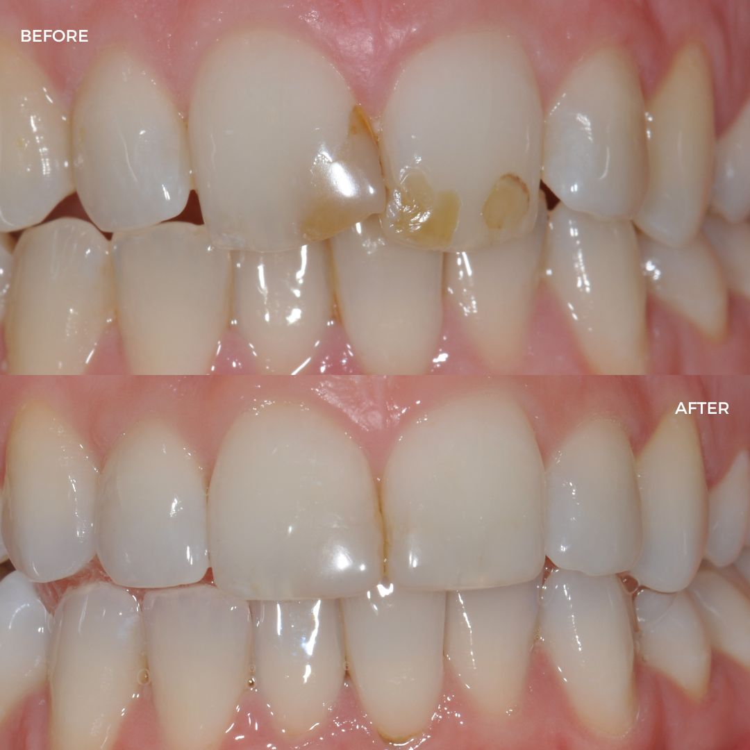 Cfast finished with edge bonding