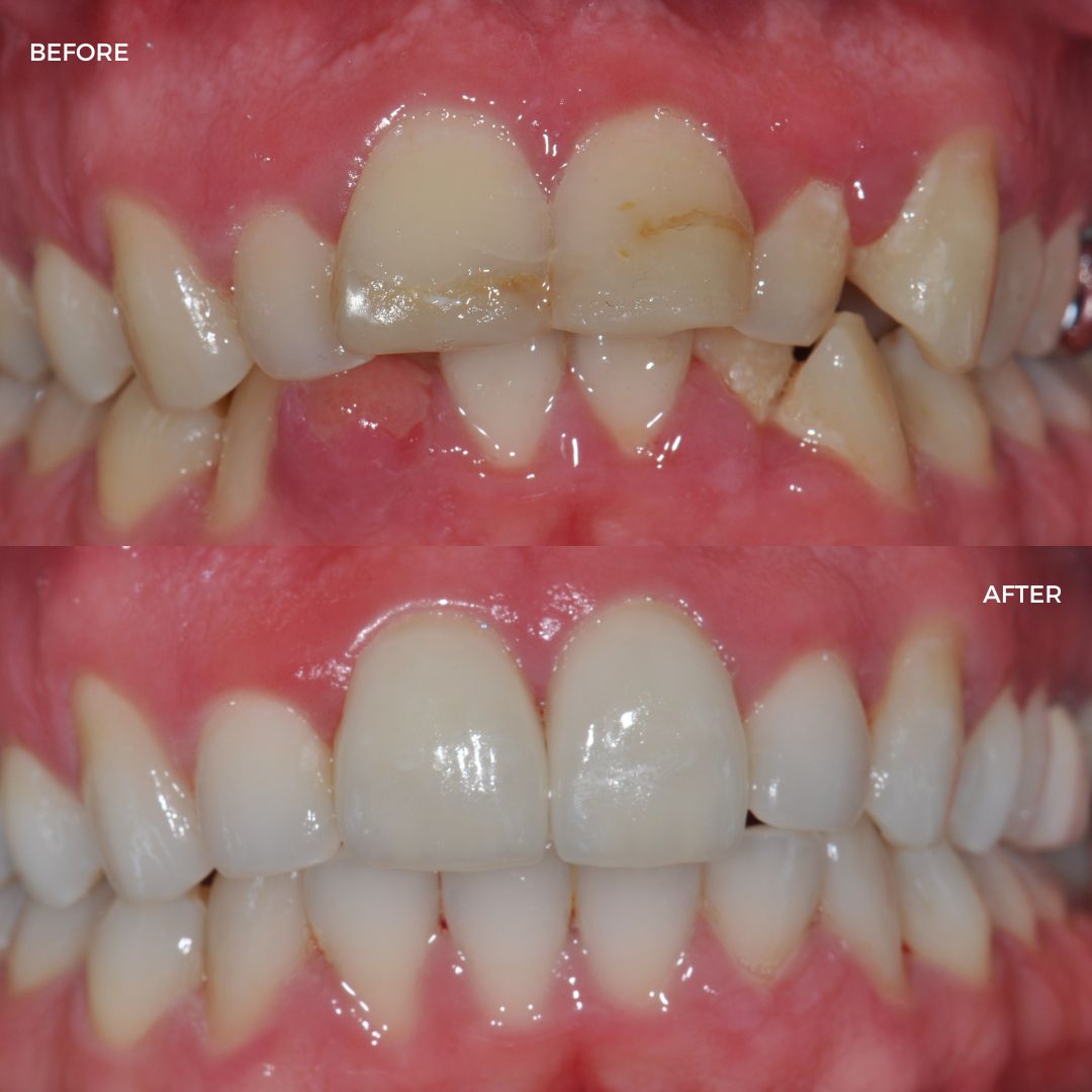 Upper and lower FastBraces, edge bonding and crowns