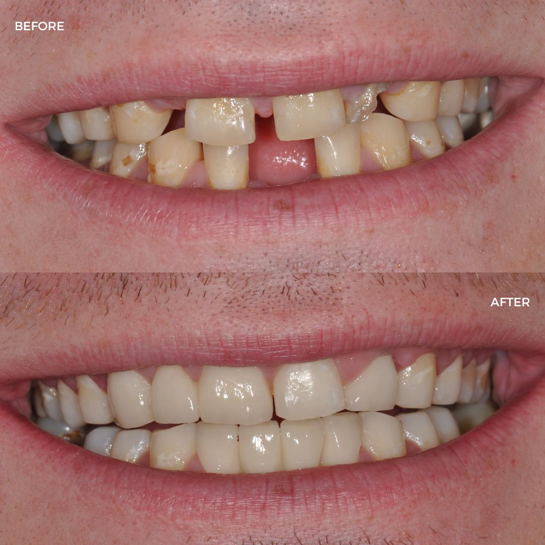 Upper and lower fastBraces finished with crown and bridge