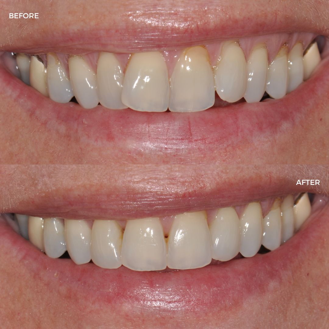 Upper and lower FastBraces and edge bonding