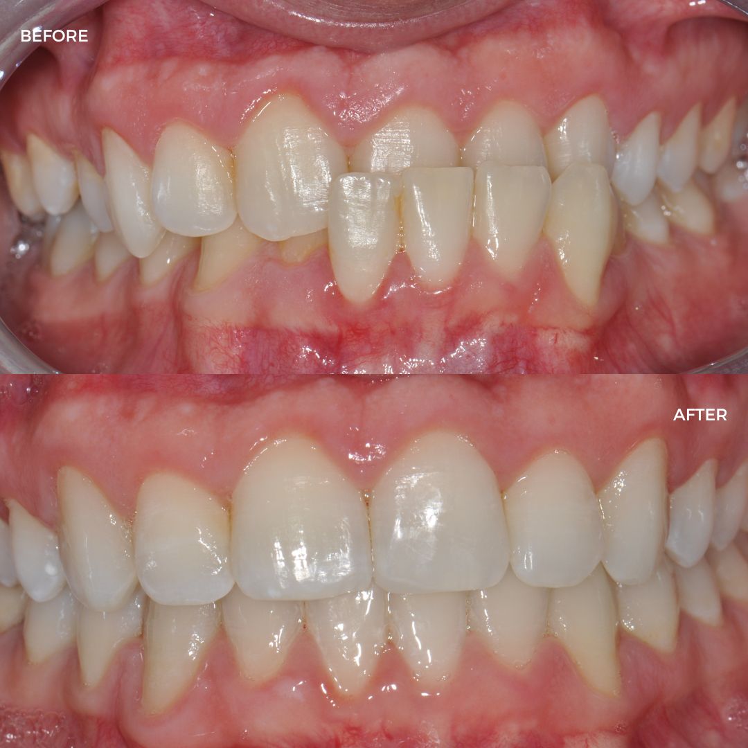Upper and lower FastBraces 5 finished with edge bonding