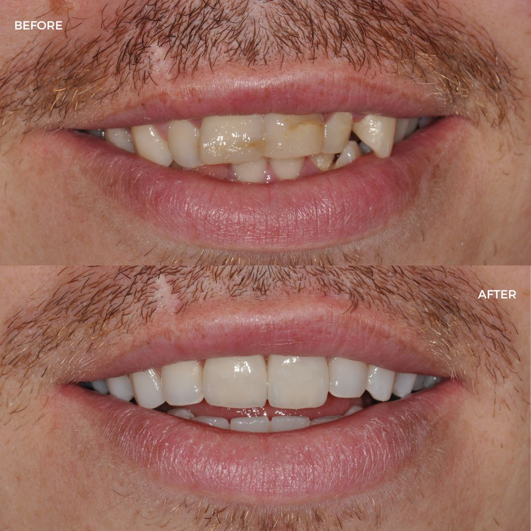 Upper and lower FastBraces, edge bonding and crowns
